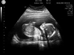 An ultrasound showing a blurry image of a fetus.